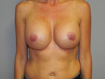 Breast augmentation Before & After Image