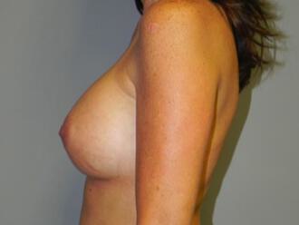 Breast Augmentation Before & After Image