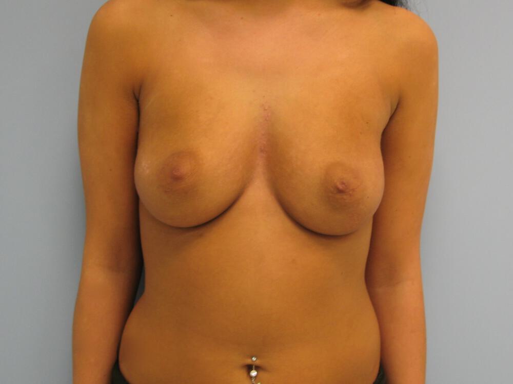 Breast augmentation Before & After Image