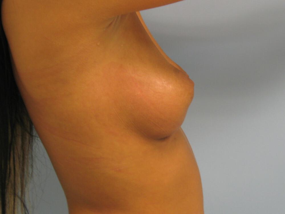Breast augmentation Before & After Image