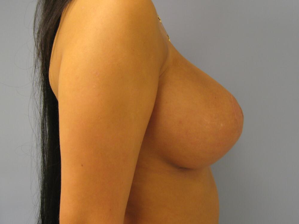 Breast augmentation Before & After Image