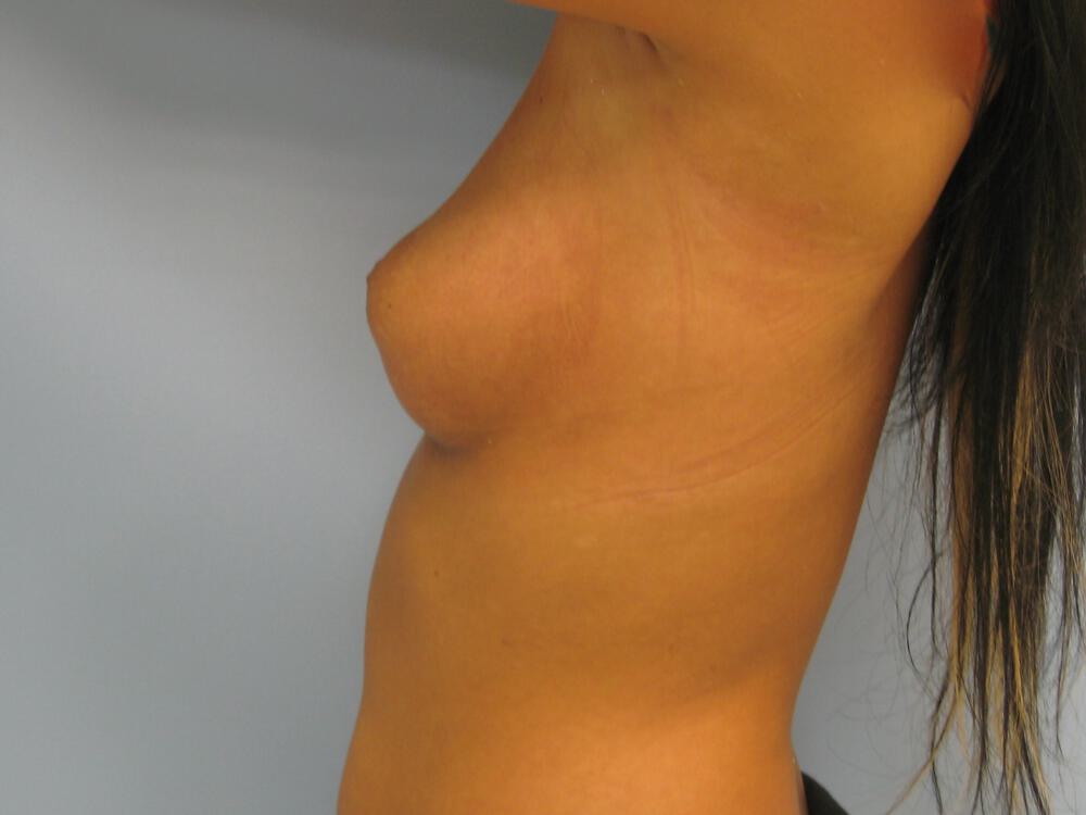Breast Augmentation Before & After Image