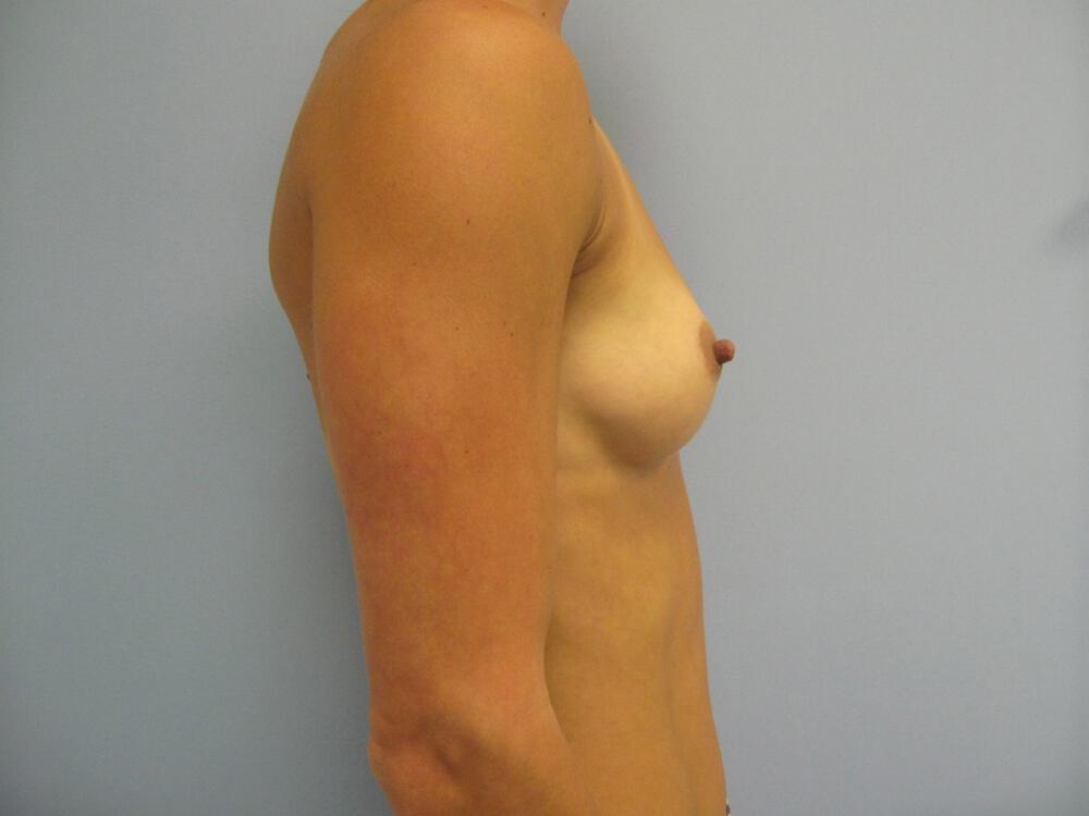 Breast augmentation Before & After Image