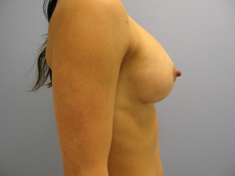 Breast augmentation Before & After Image