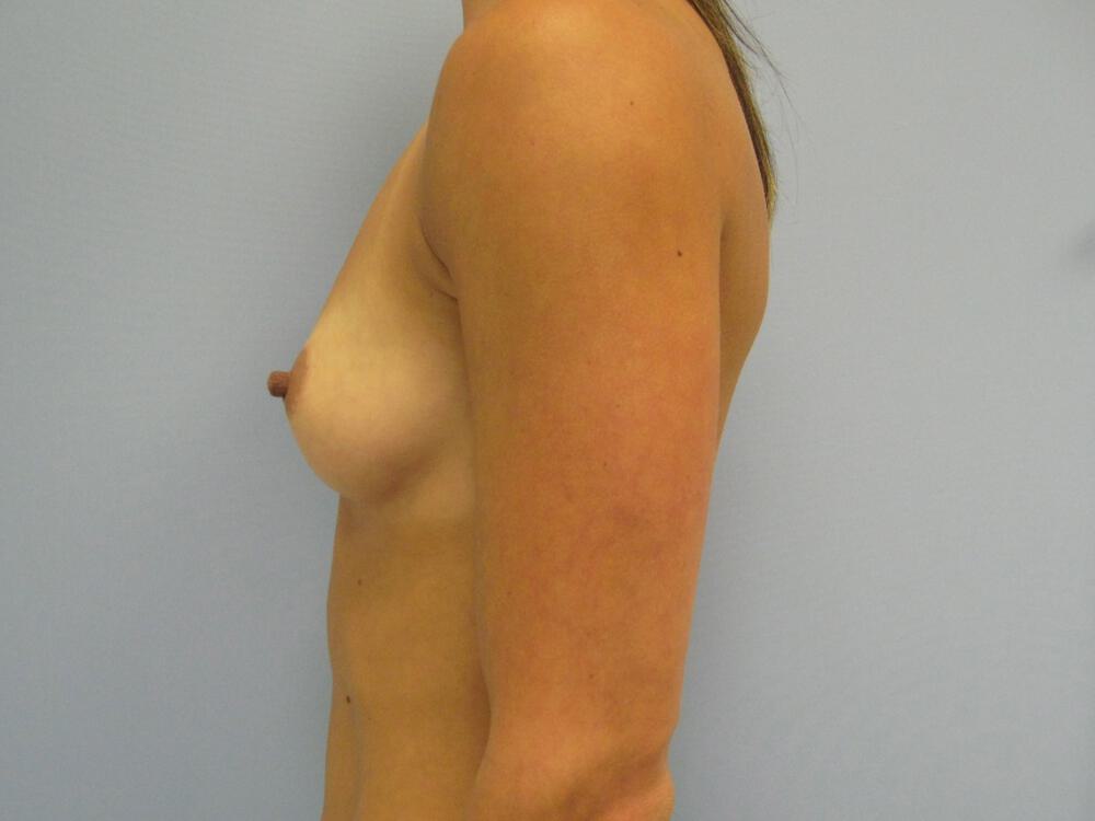 Breast Augmentation Before & After Image