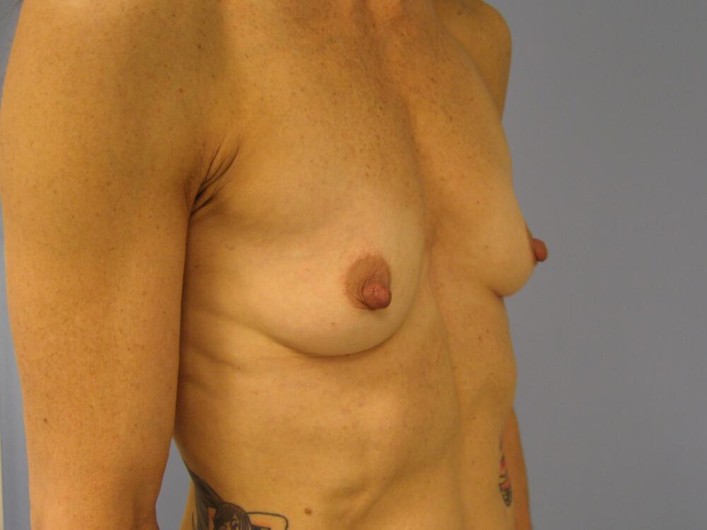 Breast augmentation Before & After Image
