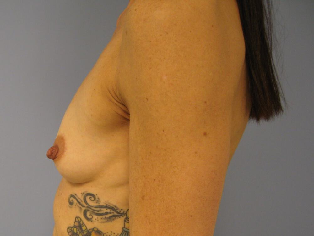 Breast augmentation Before & After Image