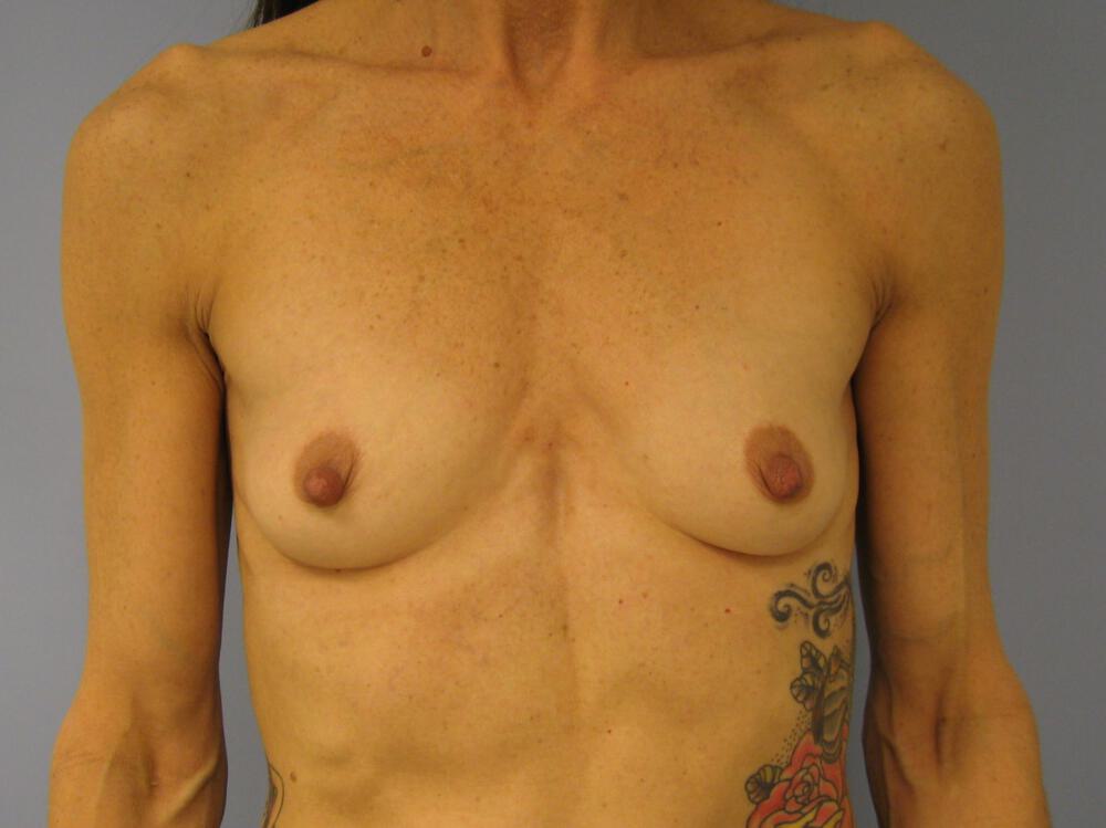 Breast Augmentation Before & After Image
