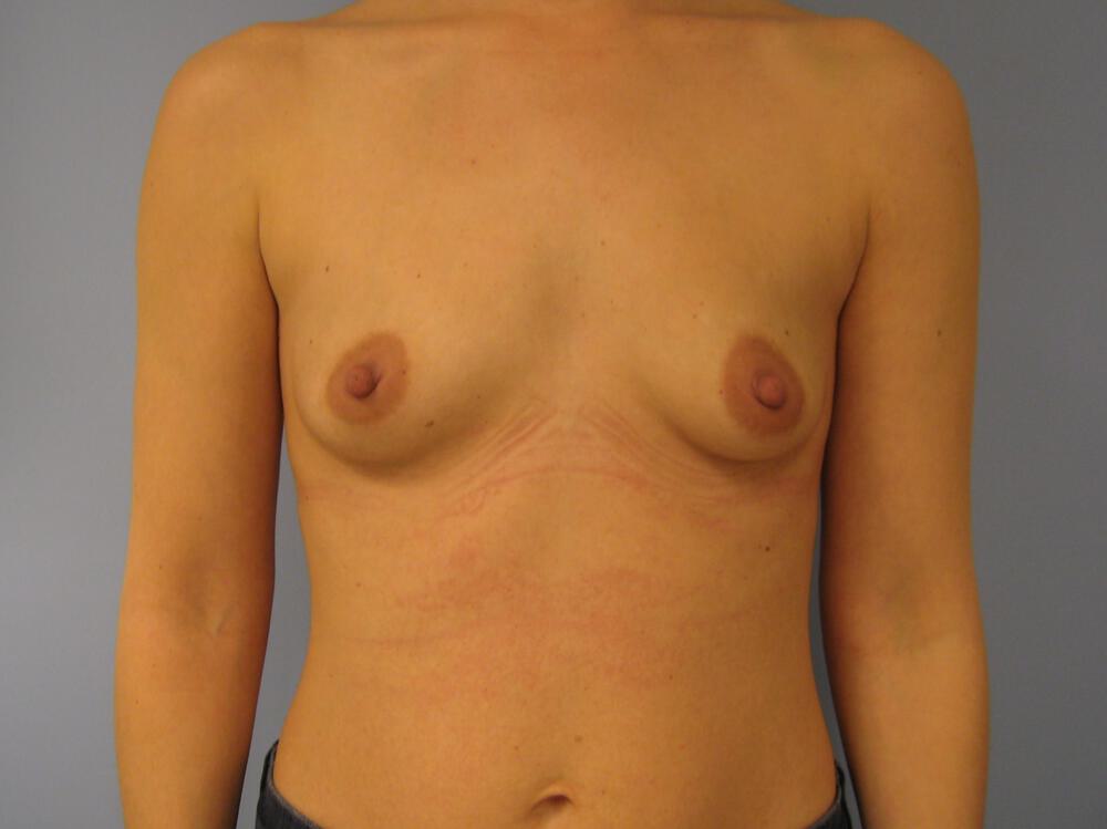 Breast augmentation Before & After Image