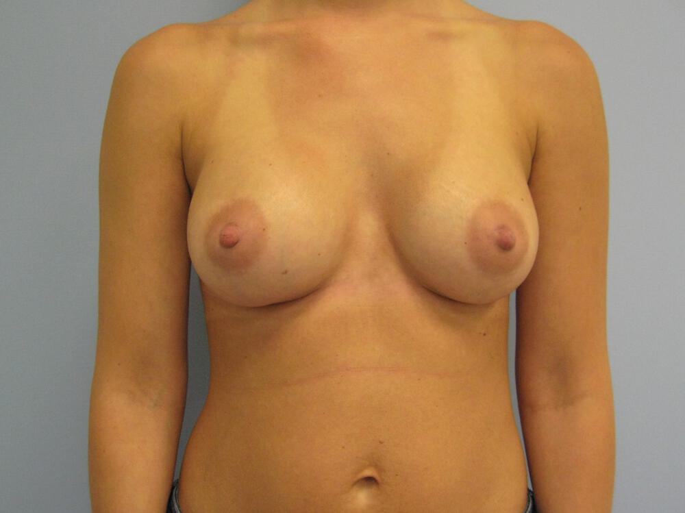Breast augmentation Before & After Image