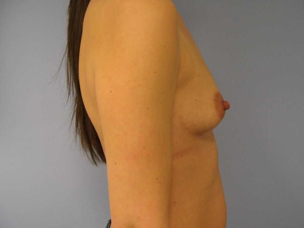 Breast Augmentation Before & After Image