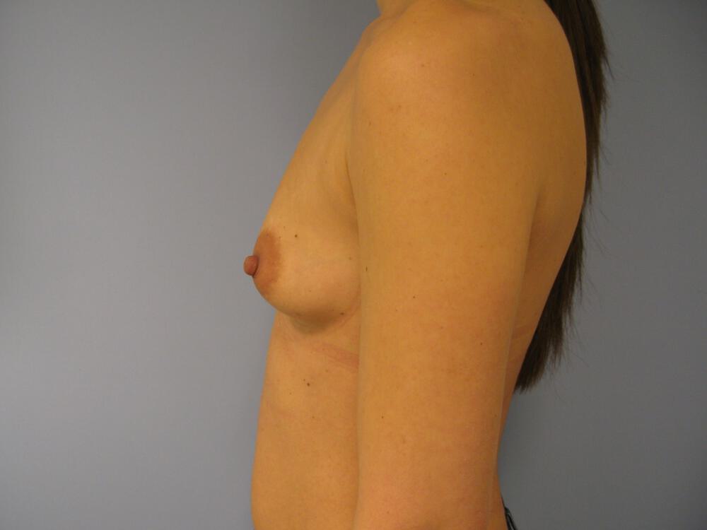 Breast Augmentation Before & After Image