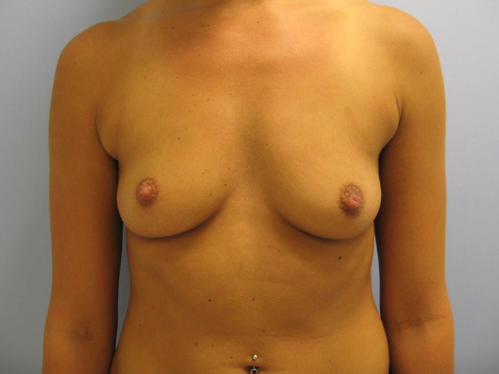 Breast augmentation Before & After Image