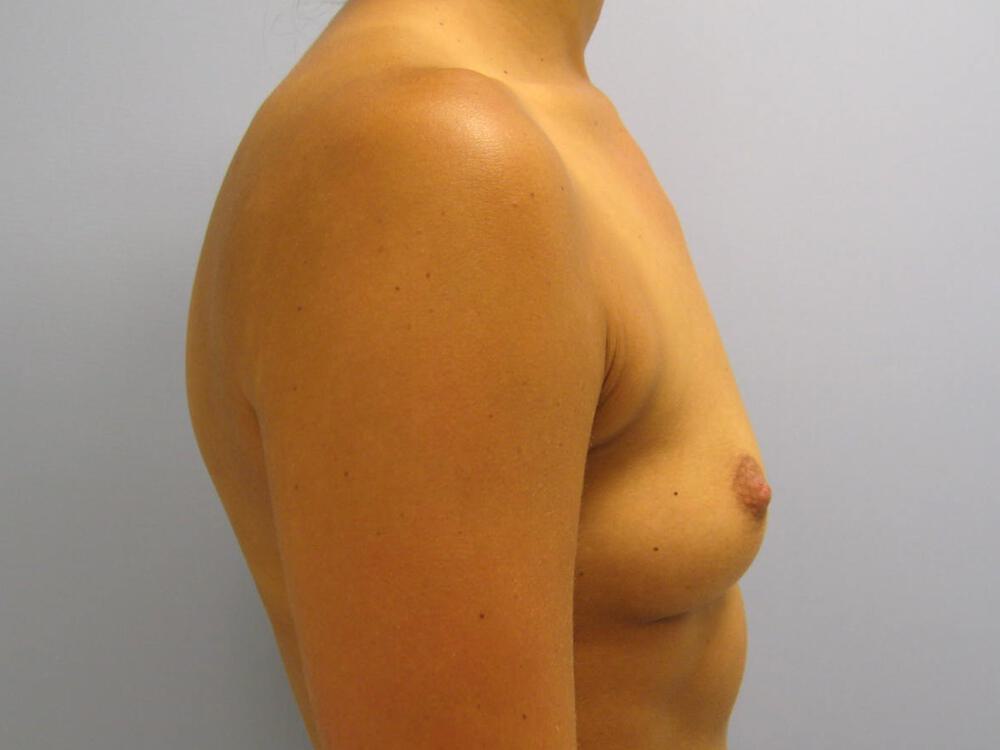 Breast augmentation Before & After Image