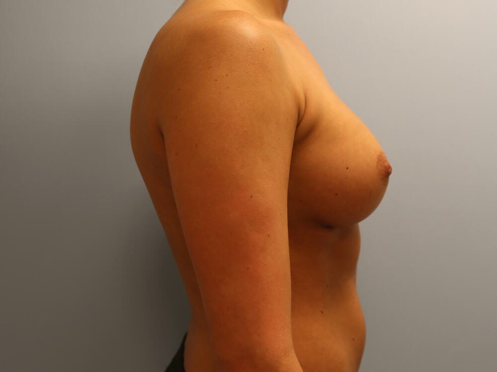 Breast augmentation Before & After Image