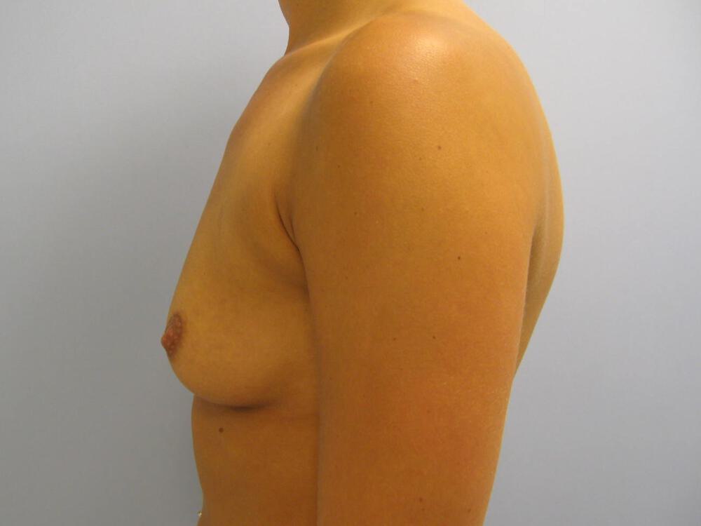 Breast Augmentation Before & After Image