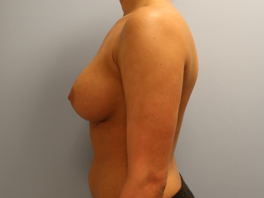Breast Augmentation Before & After Image