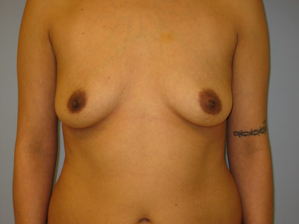 Breast augmentation Before & After Image