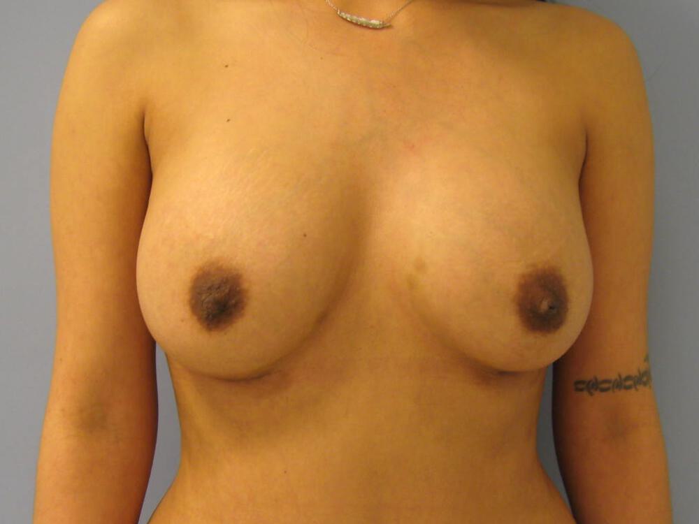 Breast augmentation Before & After Image