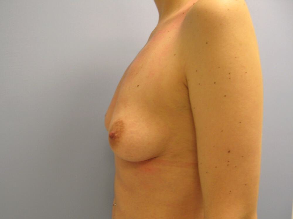 Breast augmentation Before & After Image