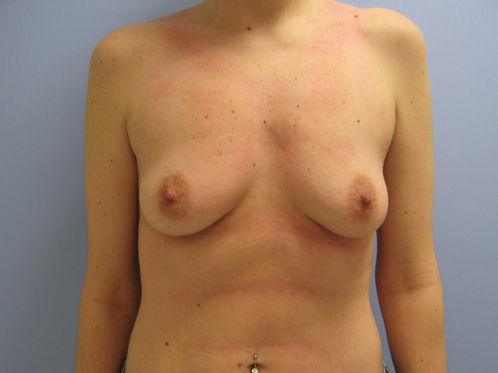 Breast augmentation Before & After Image
