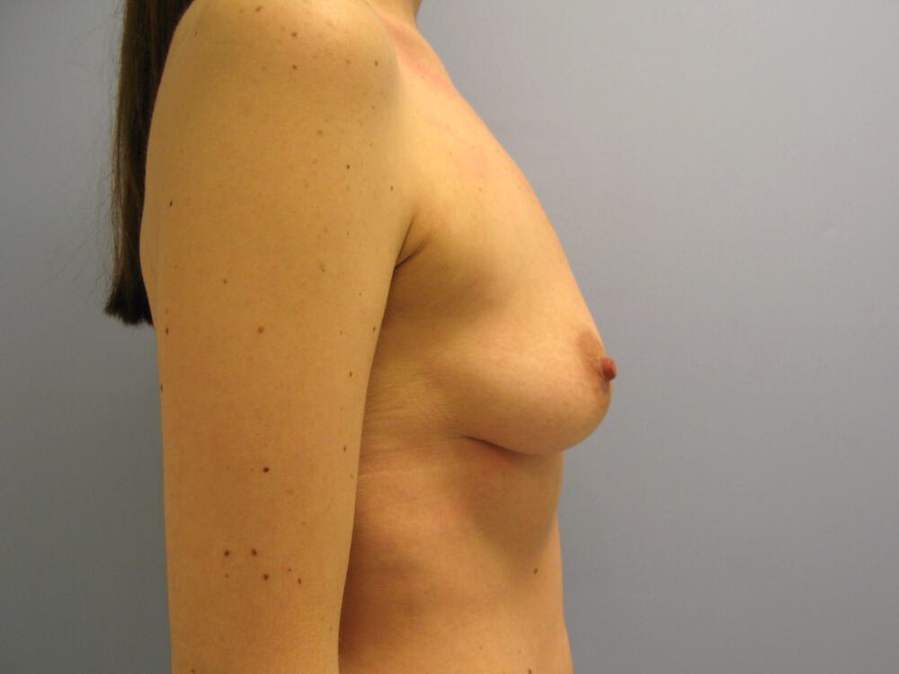 Breast Augmentation Before & After Image