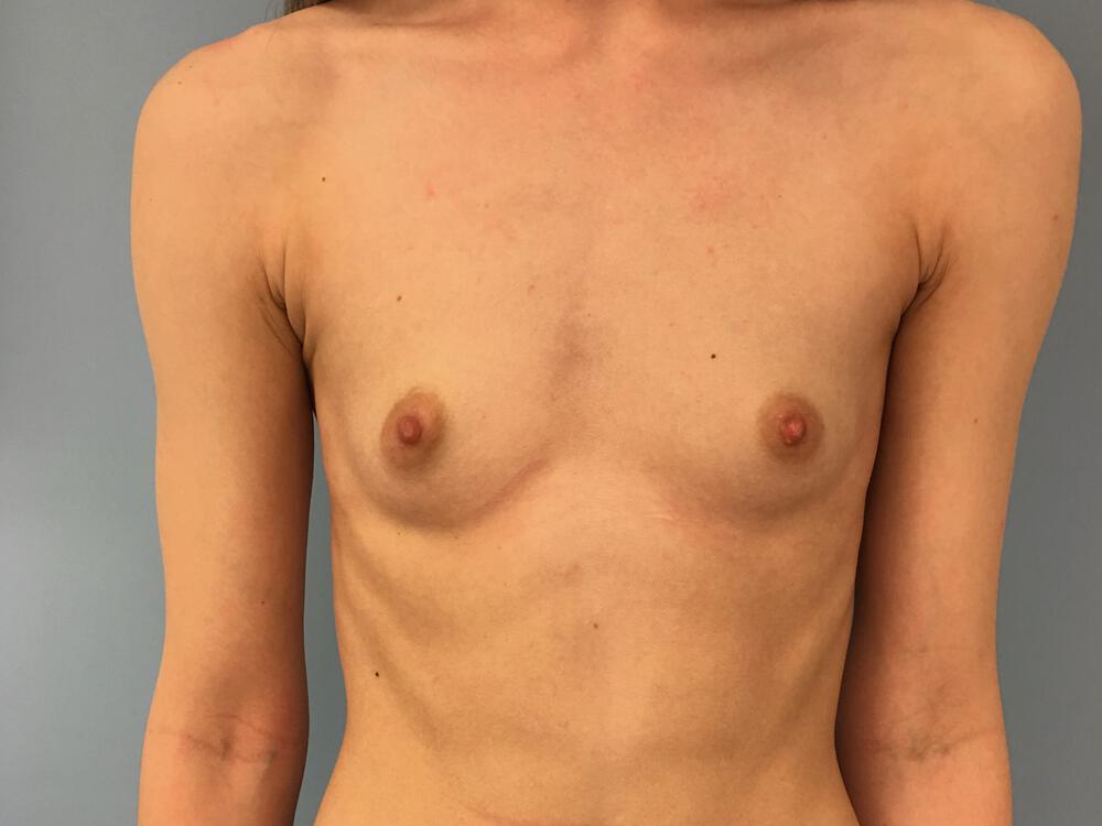 Breast augmentation Before & After Image