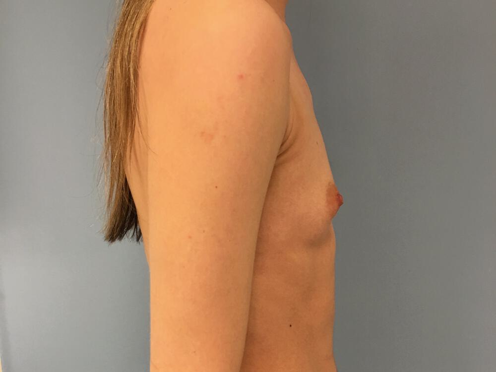 Breast Augmentation Before & After Image