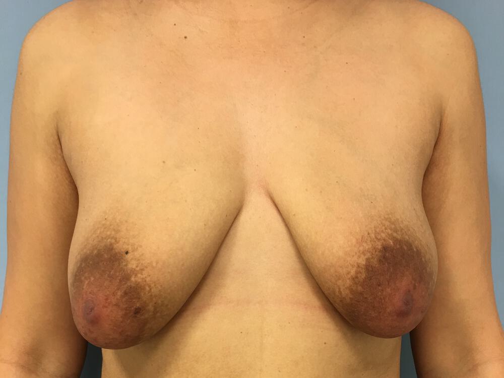 Breast augmentation Before & After Image