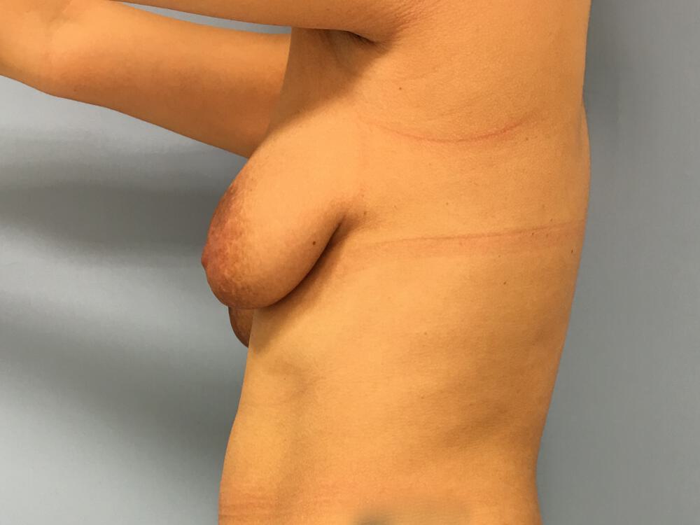 Breast Augmentation Before & After Image