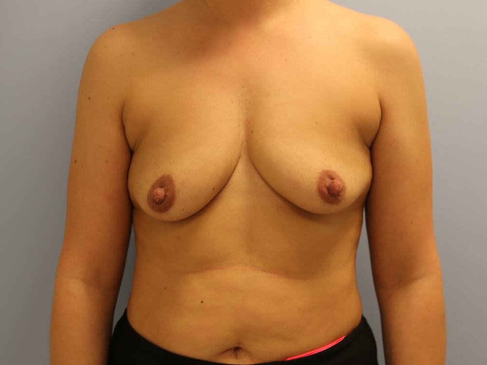 Breast augmentation Before & After Image