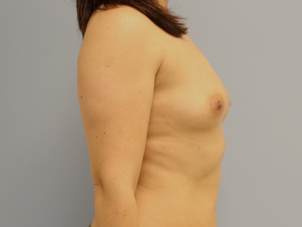 Breast Augmentation Before & After Image
