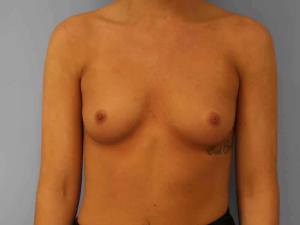 Breast augmentation Before & After Image