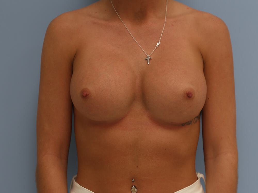 Breast augmentation Before & After Image