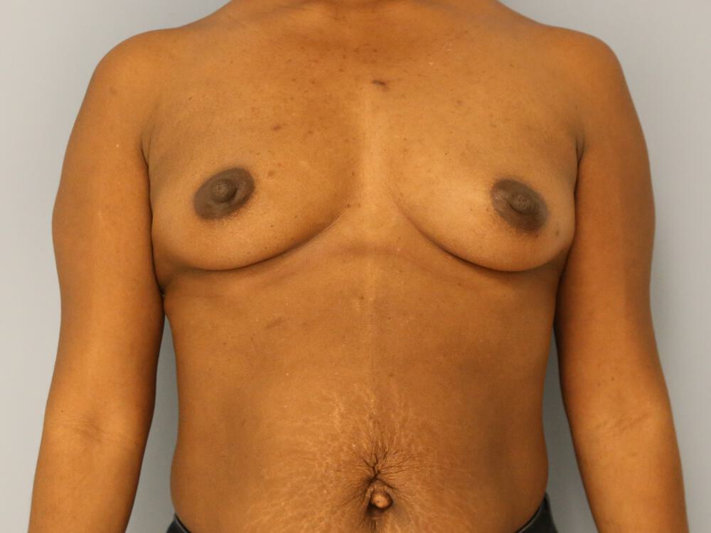 Breast Augmentation Before & After Image