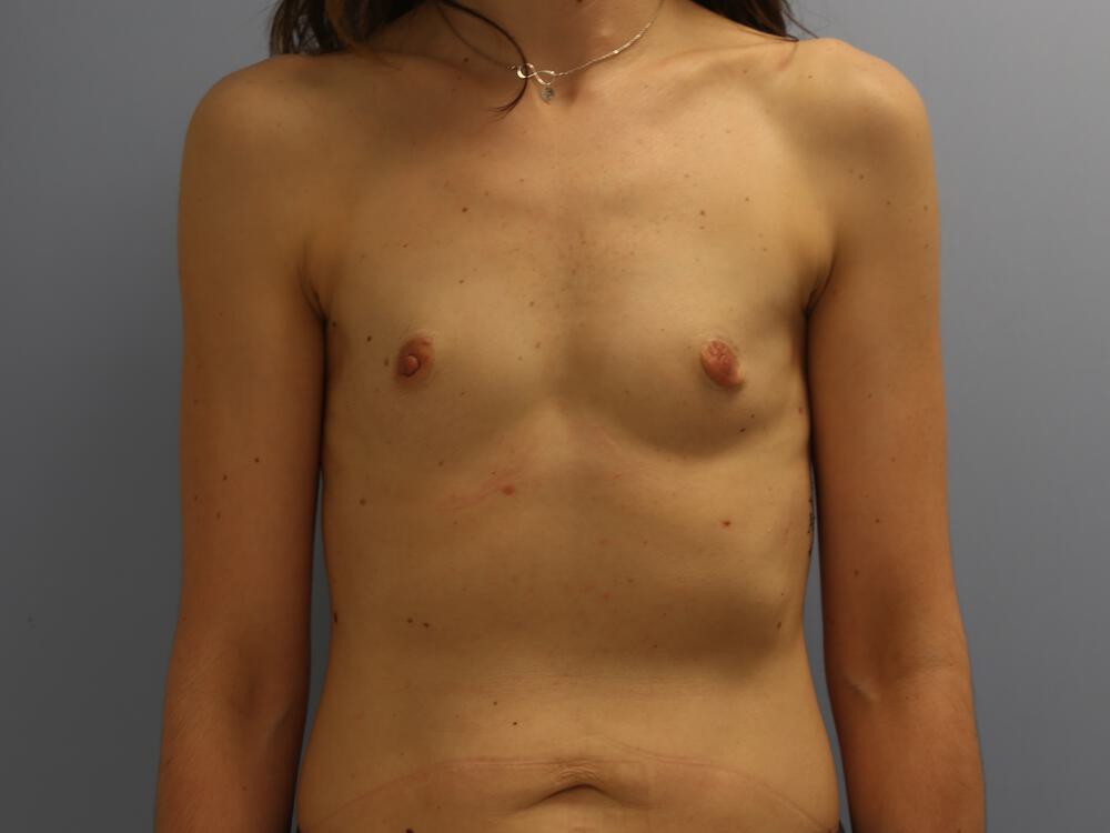 Breast augmentation Before & After Image
