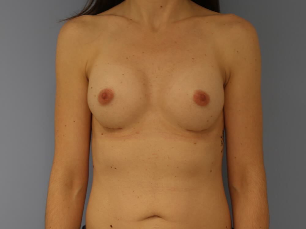 Breast augmentation Before & After Image