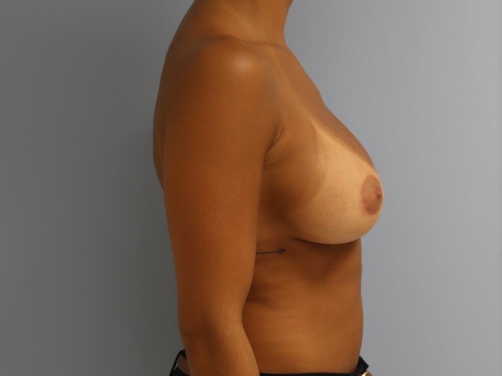 Breast Augmentation Before & After Image