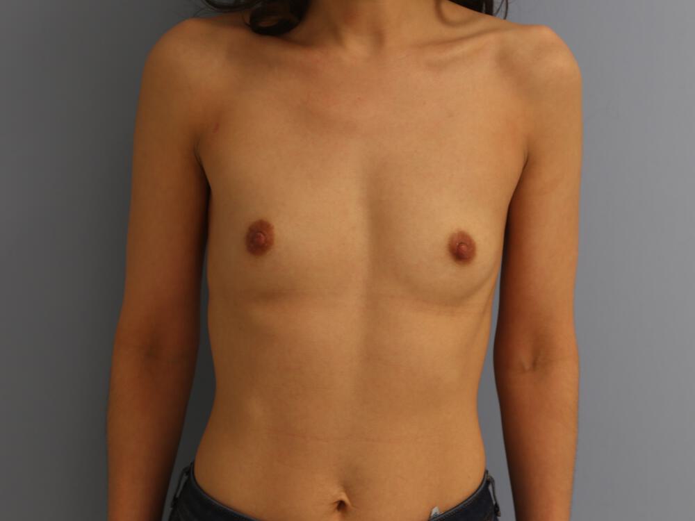 Breast augmentation Before & After Image
