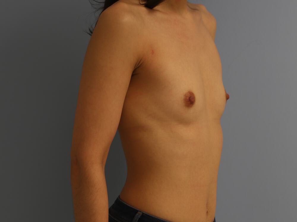 Breast augmentation Before & After Image