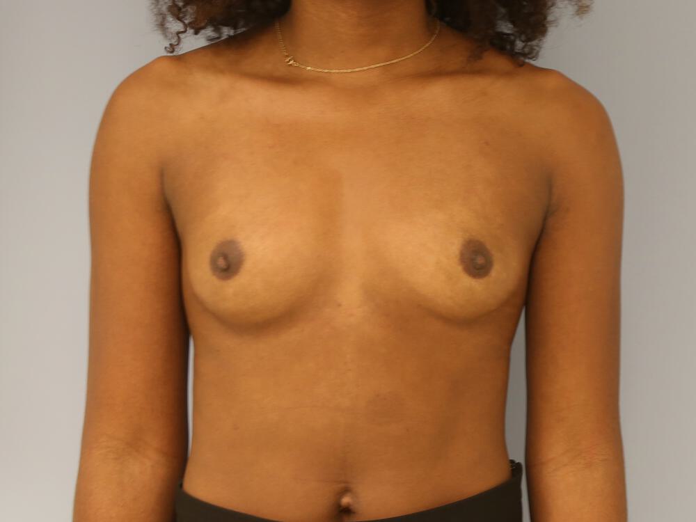 Breast augmentation Before & After Image