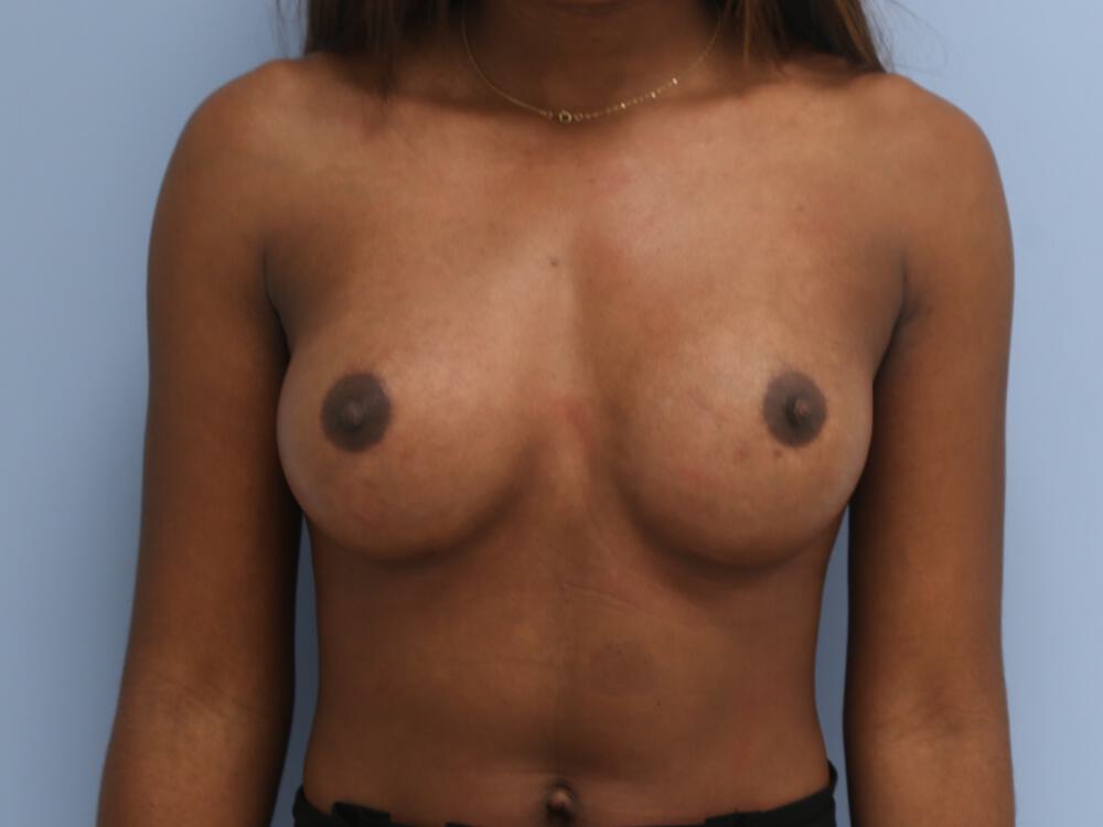 Breast augmentation Before & After Image