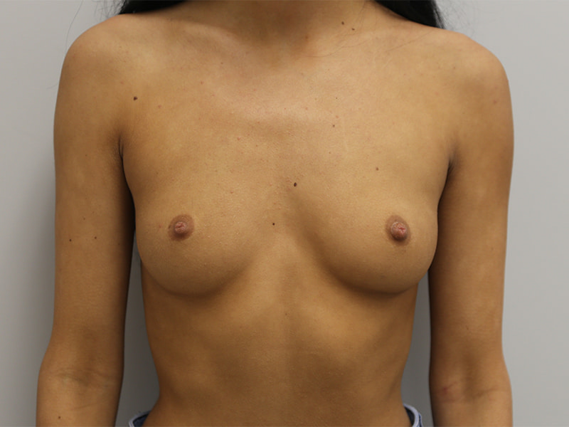 Breast augmentation Before & After Image