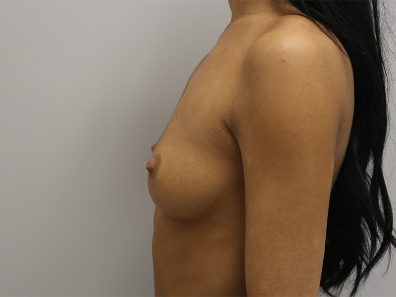 Breast Augmentation Before & After Image