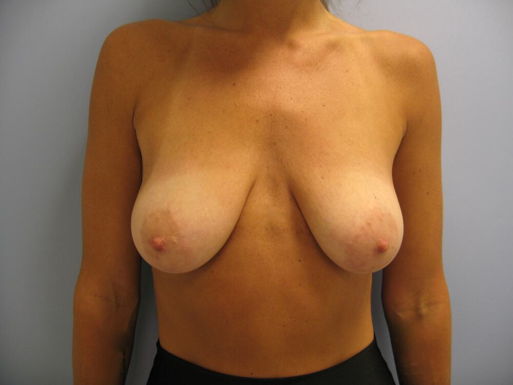 Breast lift Before & After Image