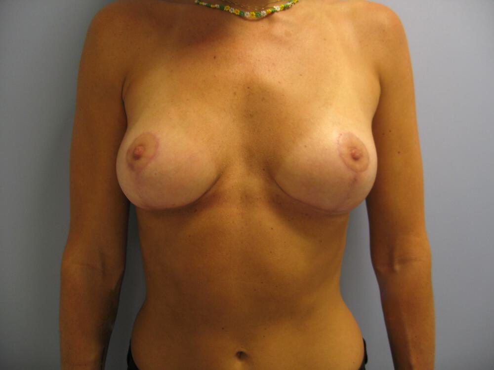 Breast lift Before & After Image