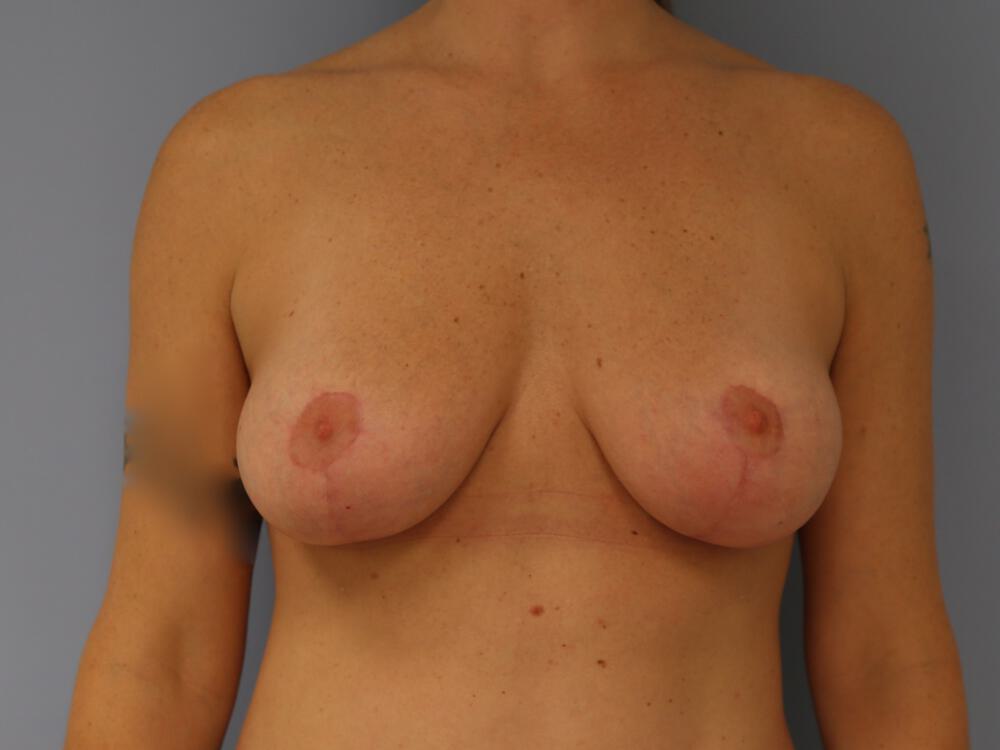 Breast lift Before & After Image