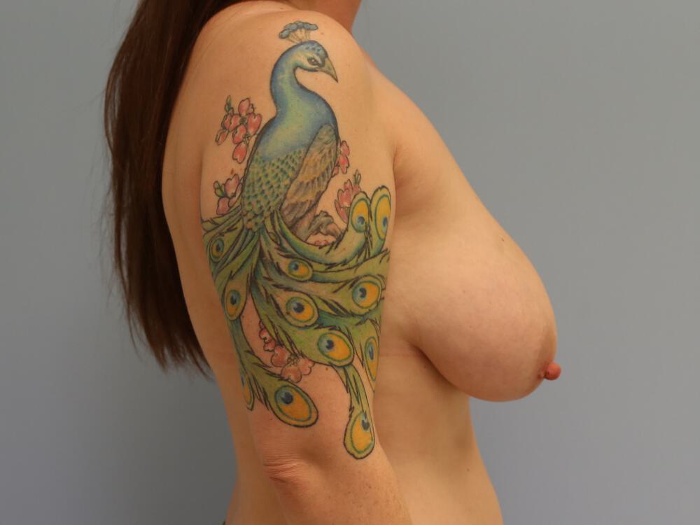 Breast lift Before & After Image