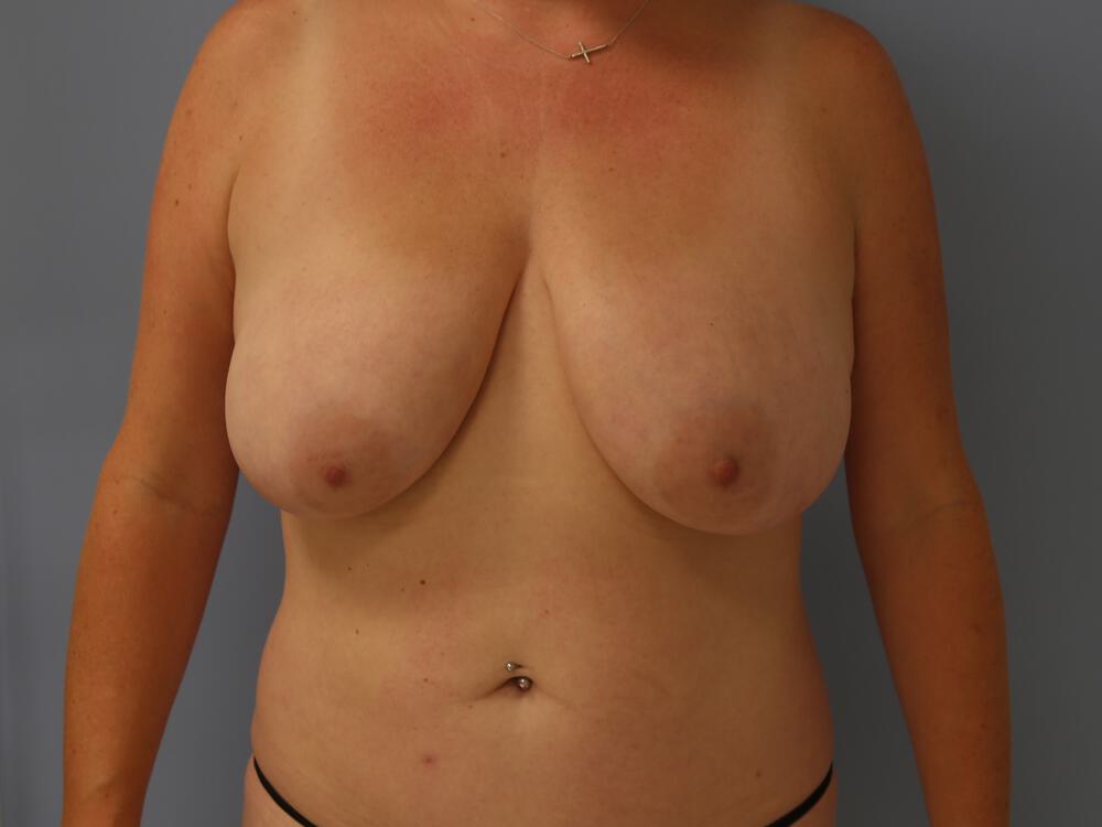 Breast lift Before & After Image
