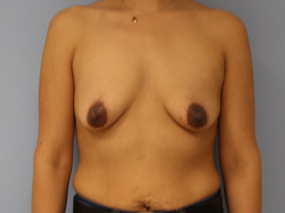 Breast lift Before & After Image